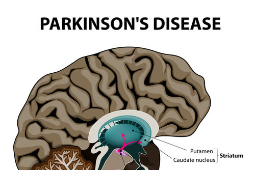 The Cause of Parkinson's Disease